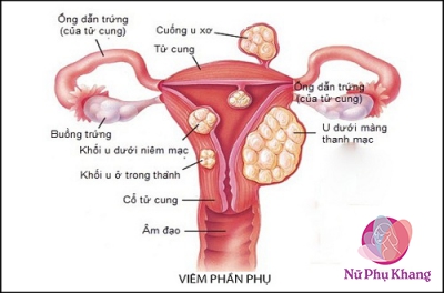 Viêm phần phụ là gì? Những điều chị em cần biết!