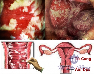 Những điều cần biết về viêm âm đạo phụ nữ ai cũng từng mắc