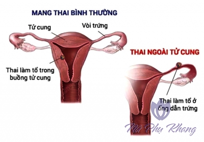 Phần phụ viêm nhiễm mãn tính dẫn đến vô sinh