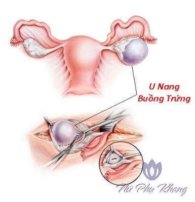 Trễ kinh và 6 căn bệnh có thể dẫn tới vô sinh