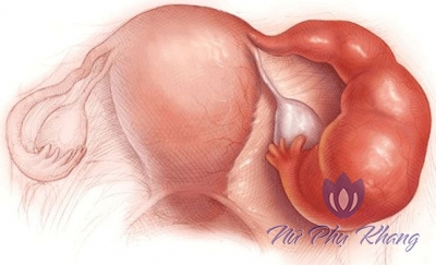 Phần phụ viêm cấp tính