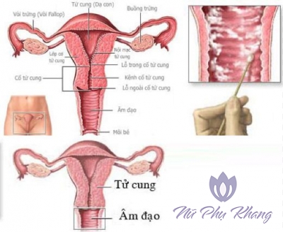 Khí hư màu xanh là bị bệnh gì, cách điều trị như thế nào? 