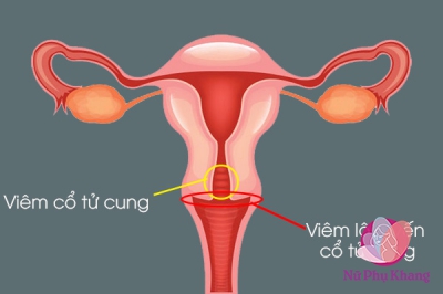 Phân biệt viêm lộ tuyến và viêm cổ tử cung