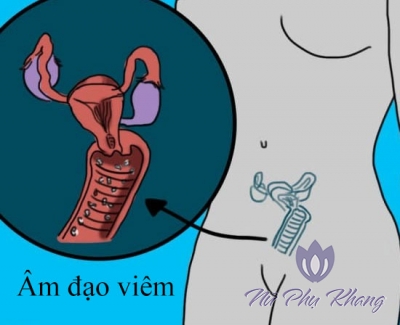 Viêm âm đạo có lây không?
