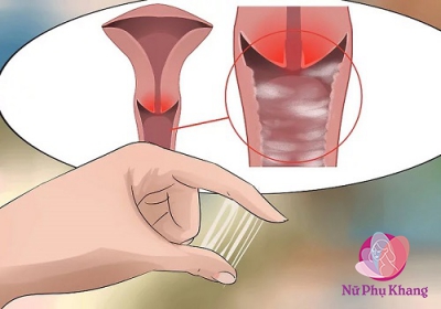 Khí hư đặc dính như keo