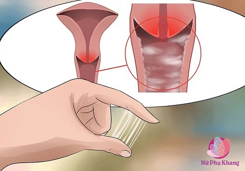 Khí hư đặc dính như keo