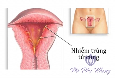 Rong kinh do tác dụng phụ của thuốc phá thai, phải làm sao?