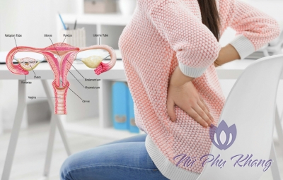 Bệnh phụ khoa ẩn sau cơn đau lưng