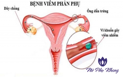 Viêm phần phụ hai bên – căn bệnh không thể coi thường