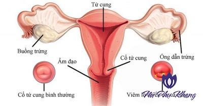 Có mấy loại viêm cổ tử cung?