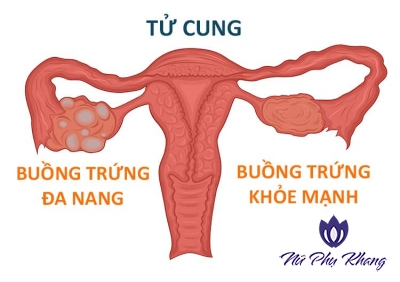Tại sao buồng trứng đa nang có thể gây vô sinh?