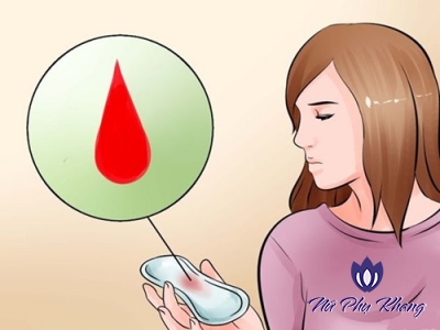 “Điểm mặt” những nguyên nhân gây xuất huyết âm đạo bất thường