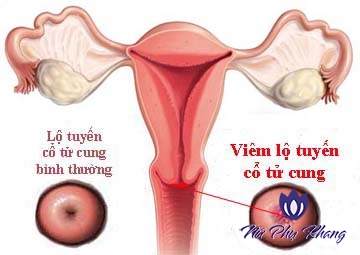 Lưu ý điều trị viêm lộ tuyến cổ tử cung cho người chưa sinh con