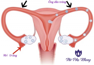 Vệ sinh vùng kín không đúng cách: Nguyên nhân sâu xa gây viêm nhiễm phần phụ
