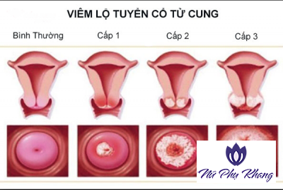 4 dấu hiệu cảnh báo bệnh viêm lộ tuyến cổ tử cung