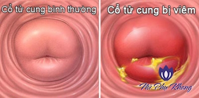 Cảnh báo 6 biến chứng nguy hiểm của viêm cổ tử cung