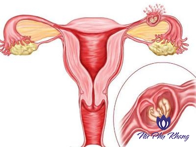 Cơ hội mang thai cho phụ nữ tắc vòi trứng 1 bên là bao nhiêu?