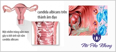 Viêm ngứa vùng kín sau khi sinh: Nỗi lo của nhiều sản phụ