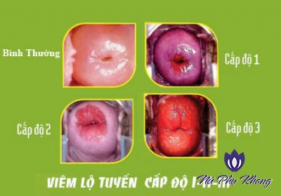 Đừng chủ quan vì bạn có thể bị vô sinh hay ung thư cổ tử cung chỉ vì chứng bệnh viêm nhiễm thường gặp này!
