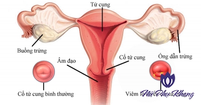 Điều trị viêm lộ tuyến cổ tử cung nên hay không nên diệt tuyến?
