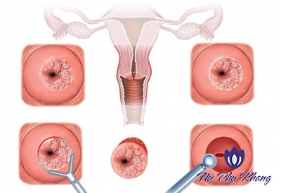 Viêm cổ tử cung có lây lan sang bạn tình không?