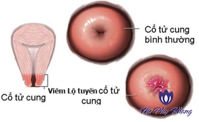 Độ tuổi nào dễ mắc viêm lộ tuyến cổ tử cung nhất?