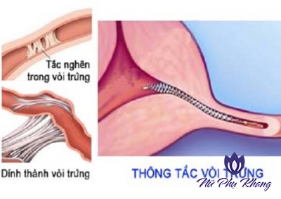 Thông tắc vòi trứng đem lại cơ hội làm mẹ cho chị em vô sinh – hiếm muộn