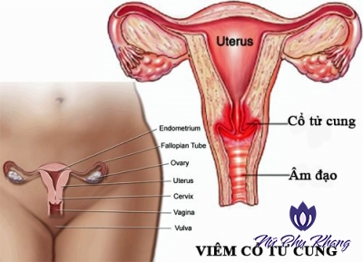 8 câu hỏi giúp chị em sớm phát hiện bệnh viêm cổ tử cung
