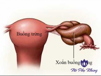 3 yếu tố gây xoắn buồng trứng – tăng nguy cơ vô sinh ở nữ giới