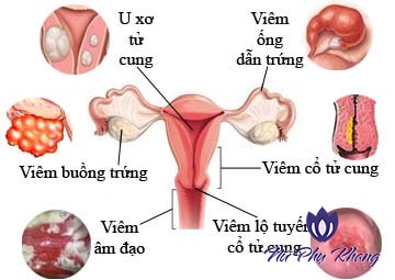 Từ A – Z những điều bạn bắt buộc phải biết về viêm nhiễm phụ khoa