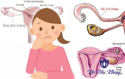 Viêm nhiễm âm đạo gây tắc ống dẫn trứng: biến chứng khó lường