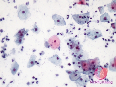 Viêm âm đạo do Trichomoniasis: Bệnh lây qua đường tình dục phổ biến nhất