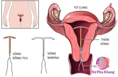 Thực hư chuyện bị rong kinh do đặt vòng tránh thai