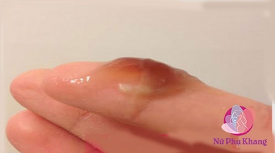 Khí hư lẫn máu cảnh báo 7 bệnh phụ khoa nguy hiểm