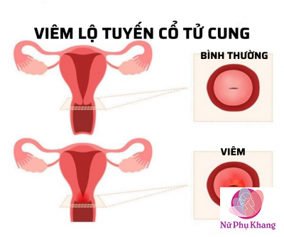 Chữa viêm lộ tuyến theo Đông Y